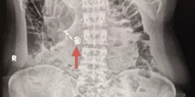 Une femme avale un écouteur sans fil, le confondant avec un comprimé