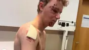 Albert Withen Philipsen, espoir du cyclisme, lourdement blessé à l'entraînement