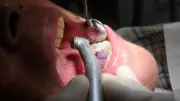 Ancien dentiste de Lozère jugé pour avoir arraché des dents saines