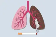 Cancer du poumon : lancement d'un dépistage gratuit pour 20 000 fumeurs
