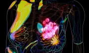 Cancer du sein : risque accru de maladies cardiovasculaires après traitement