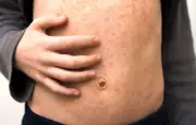 Rougeole : une résurgence inquiétante en France malgré la vaccination