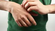 Eczéma : le combat d'Hippolyte contre les démangeaisons et les regards