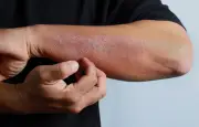 Eczéma : nouvelles molécules, espoirs et défis pour les patients