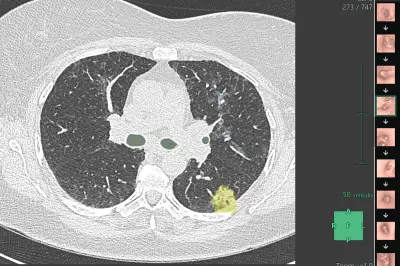 Au CHU de Nice, un logiciel 3D guide les biopsies pulmonaires