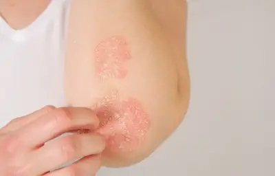 Psoriasis résistant : une mutation génétique identifiée, espoir de traitement
