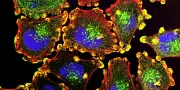 Cancer: Un mélanome métastatique disparaît après une infection post-chirurgie cardiaque