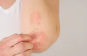 Psoriasis résistant : une mutation génétique identifiée, espoir de traitement