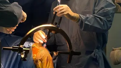 Première au CHU de Montpellier : laser contre l'épilepsie