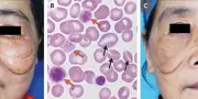Cholestérol élevé : un demi-siècle d'erreur de diagnostic