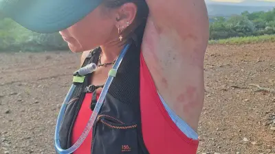Eczéma : à Perpignan, Pauline Lopez raconte son combat contre la maladie