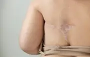 Déremboursement du Zoladex : des patients inquiets