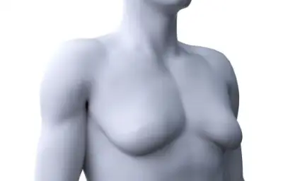 Gynécomastie : opération ou traitement hormonal, comment s’en sortir